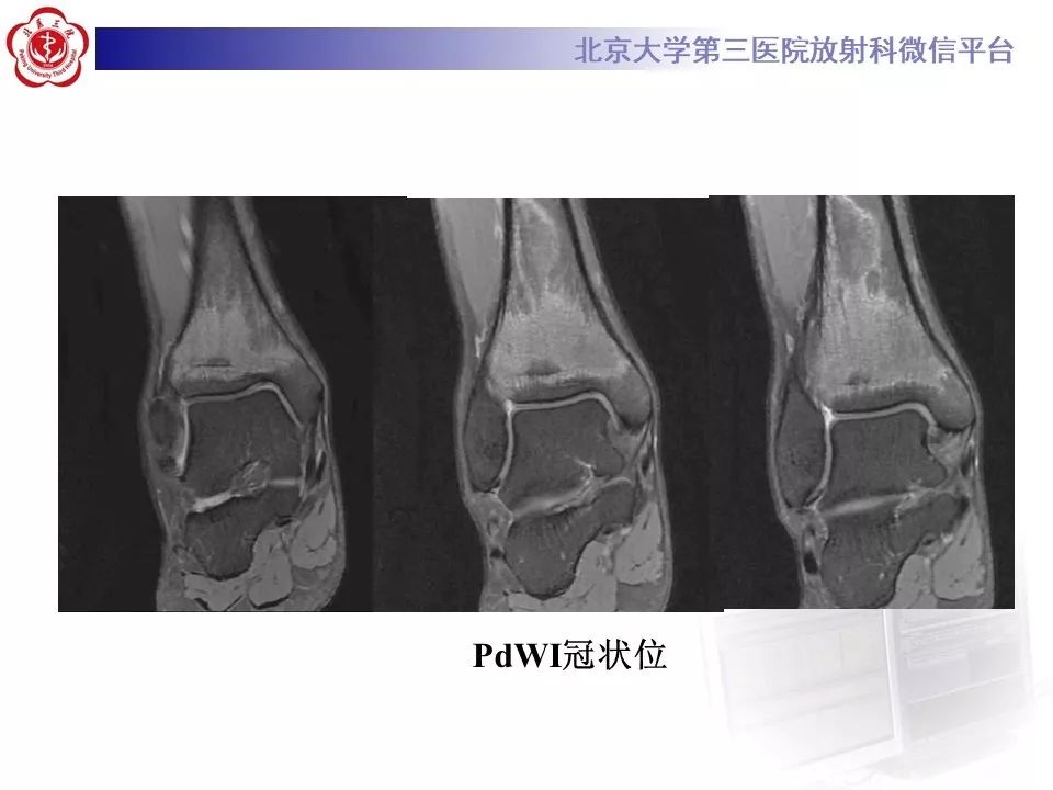 【PPT】ERDHEIM-CHESTER病的影像
