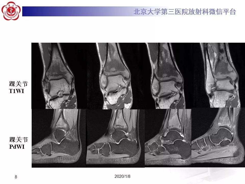 【PPT】ERDHEIM-CHESTER病的影像