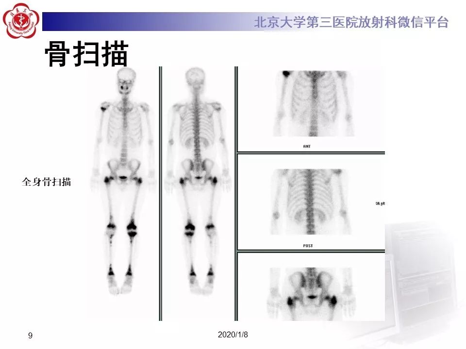 【PPT】ERDHEIM-CHESTER病的影像