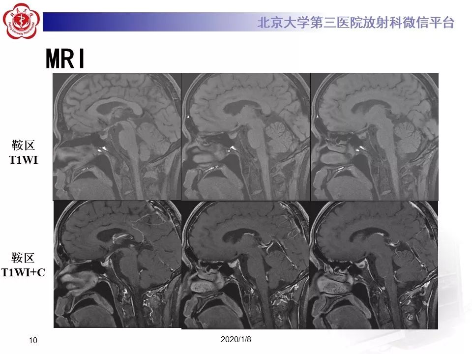 【PPT】ERDHEIM-CHESTER病的影像