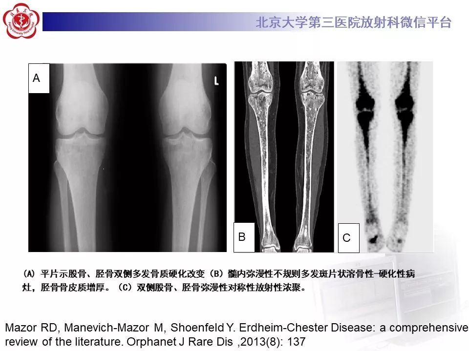 【PPT】ERDHEIM-CHESTER病的影像