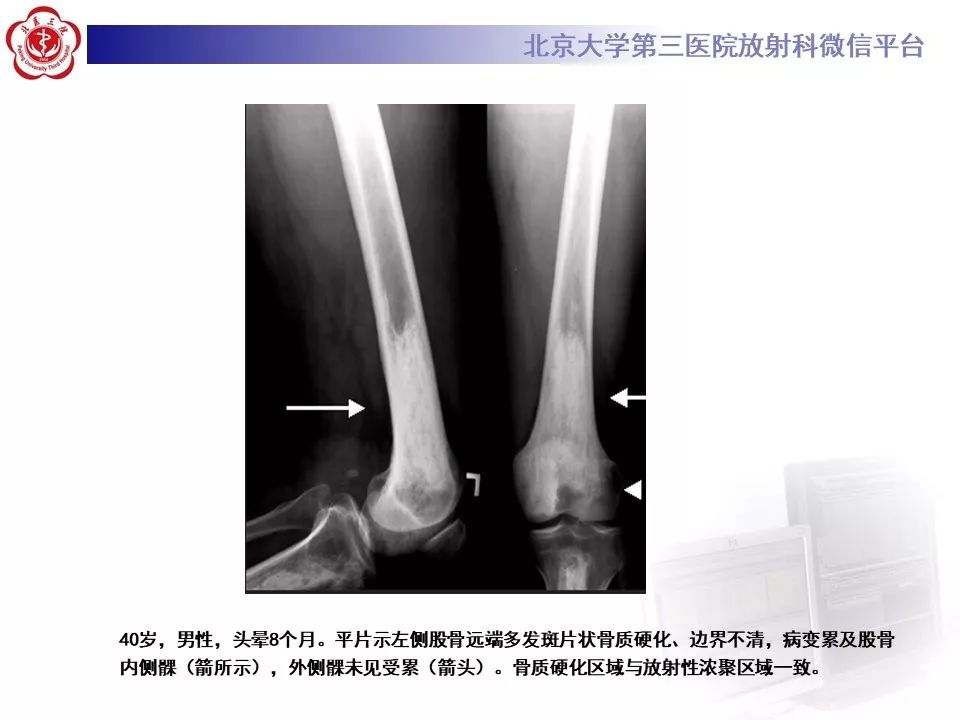 【PPT】ERDHEIM-CHESTER病的影像