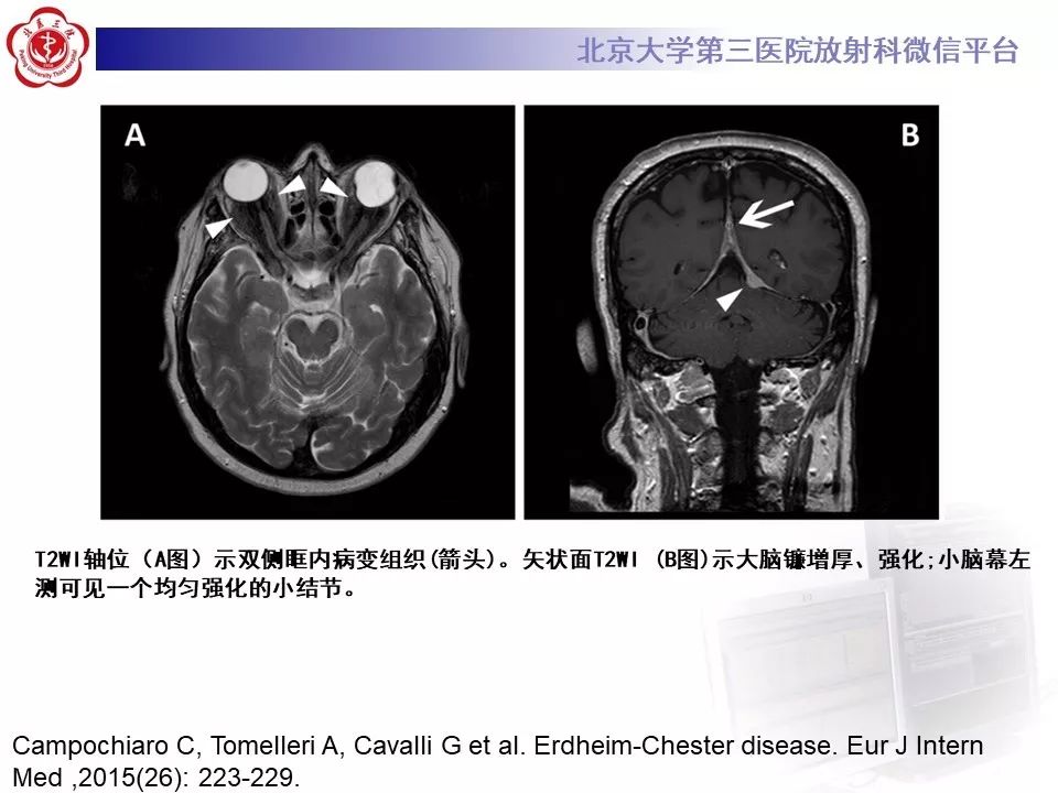 【PPT】ERDHEIM-CHESTER病的影像