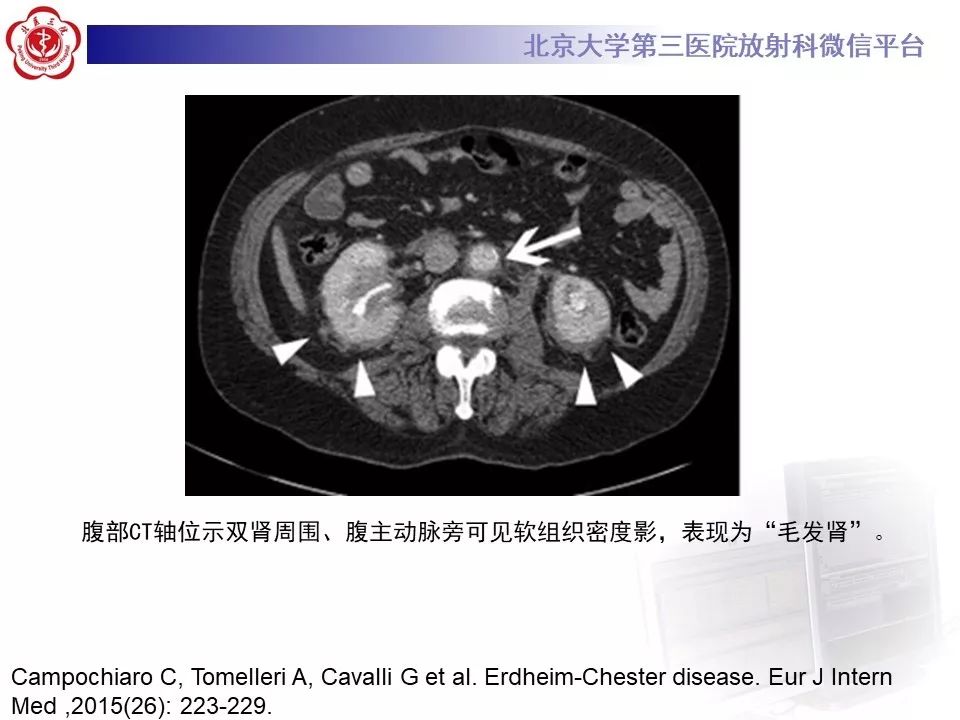 【PPT】ERDHEIM-CHESTER病的影像