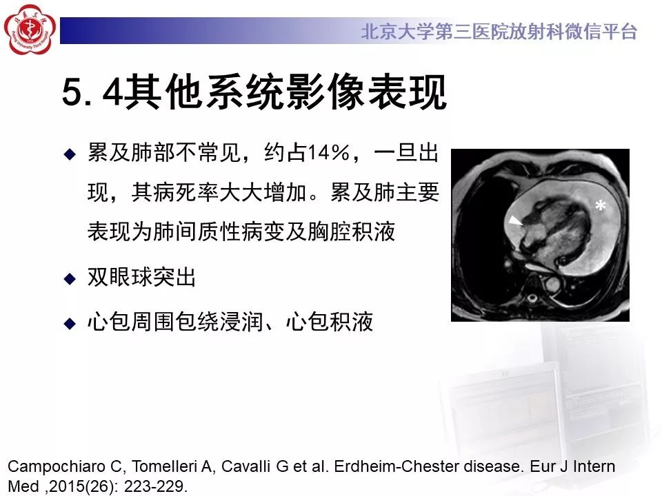 【PPT】ERDHEIM-CHESTER病的影像