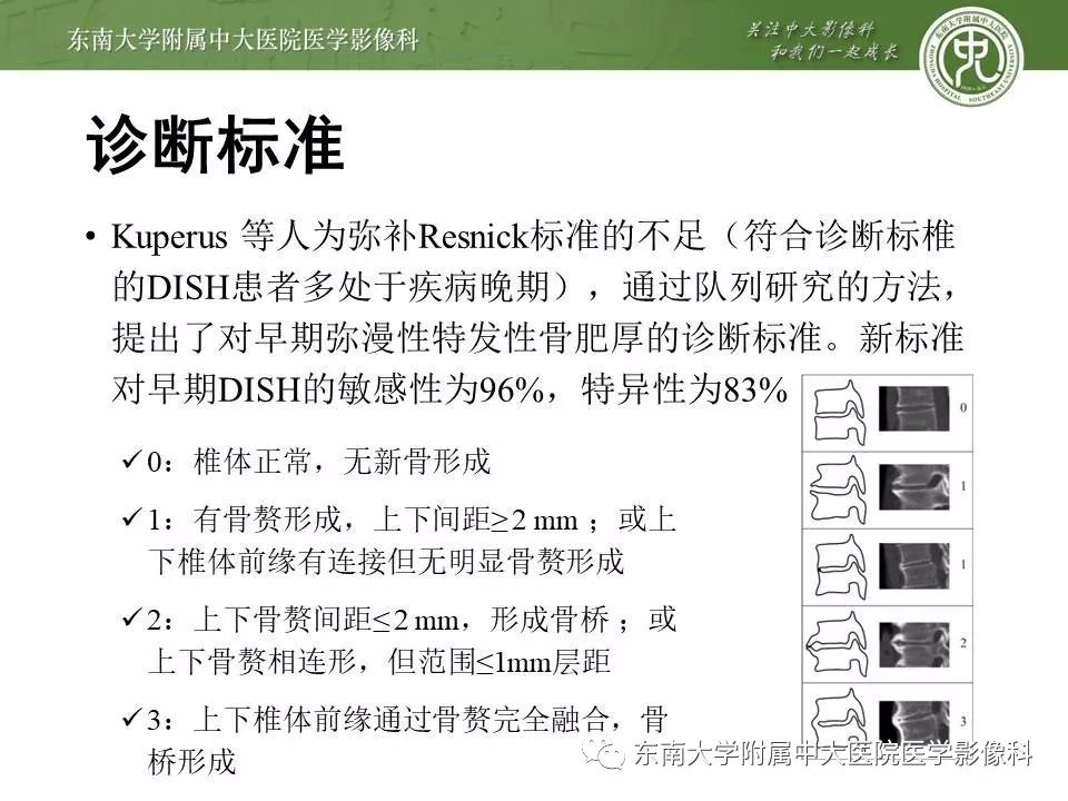 【PPT】弥漫性特发性骨肥厚