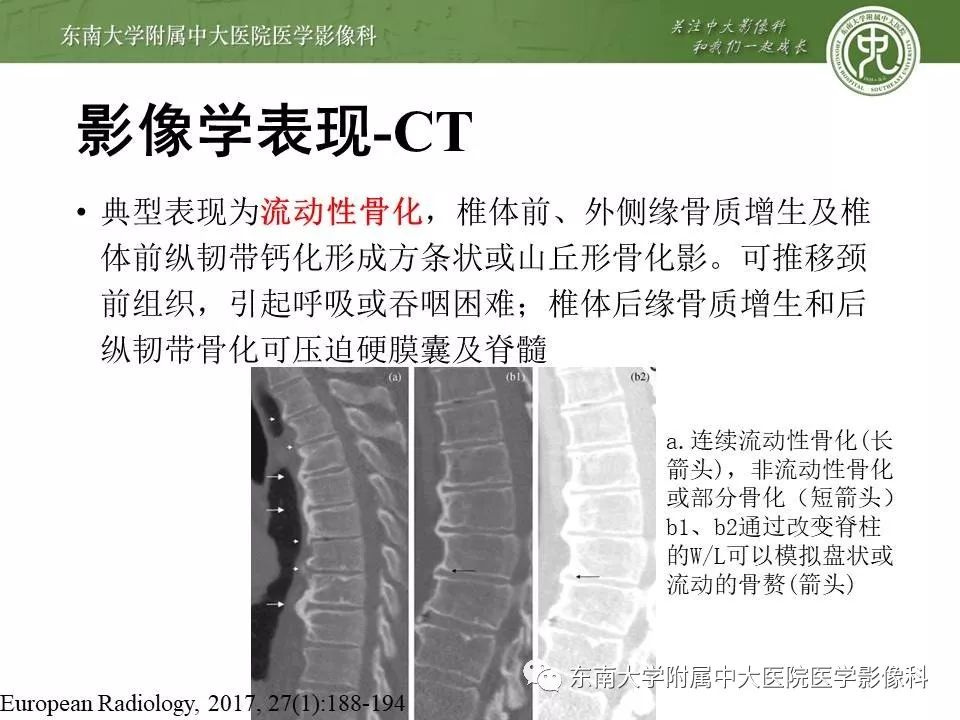 【PPT】弥漫性特发性骨肥厚