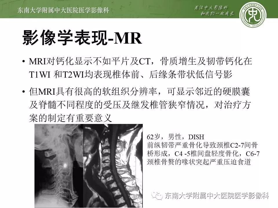 【PPT】弥漫性特发性骨肥厚