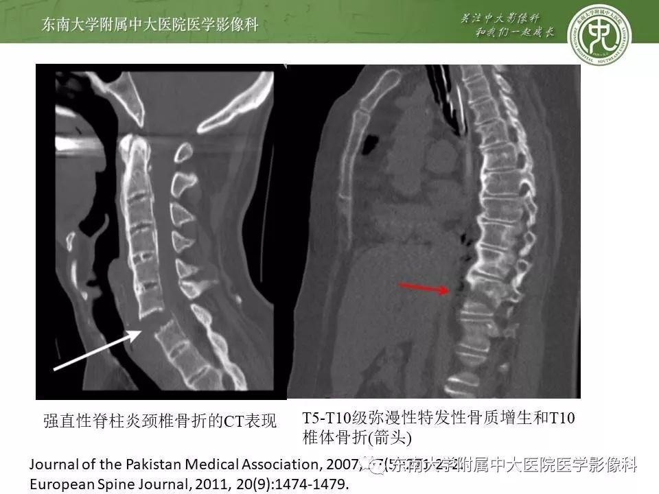 【PPT】弥漫性特发性骨肥厚