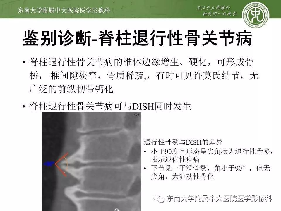 【PPT】弥漫性特发性骨肥厚