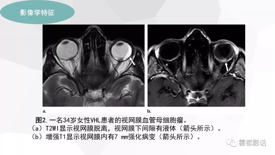 【PPT】希佩尔-林道综合征(VHL 综合征)