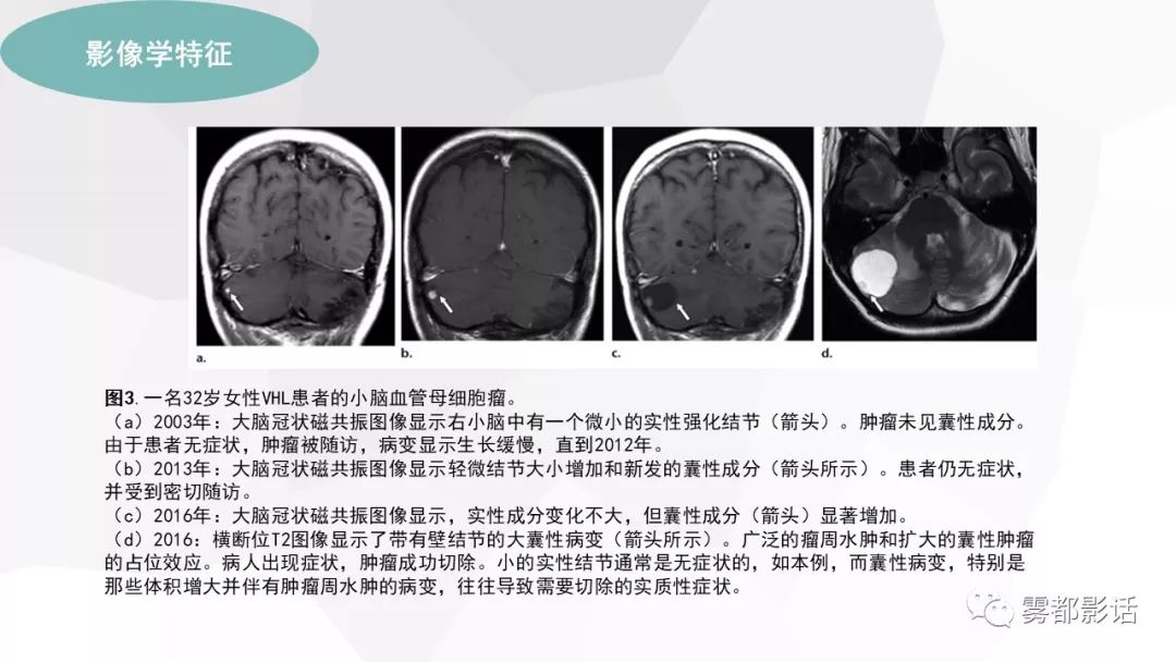 【PPT】希佩尔-林道综合征(VHL 综合征)