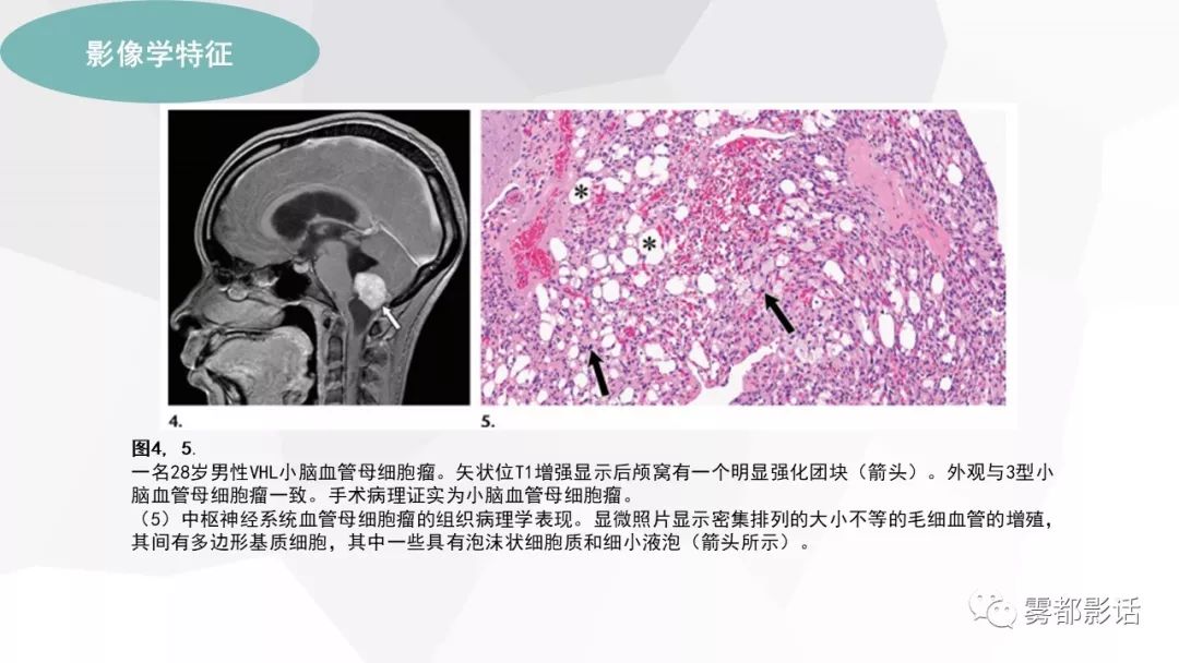 【PPT】希佩尔-林道综合征(VHL 综合征)