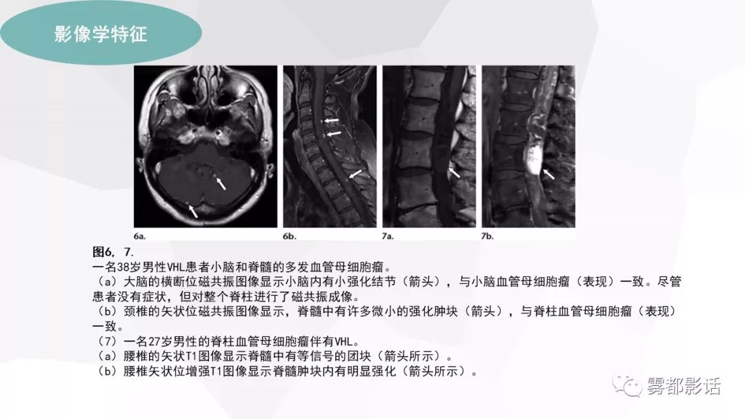 【PPT】希佩尔-林道综合征(VHL 综合征)
