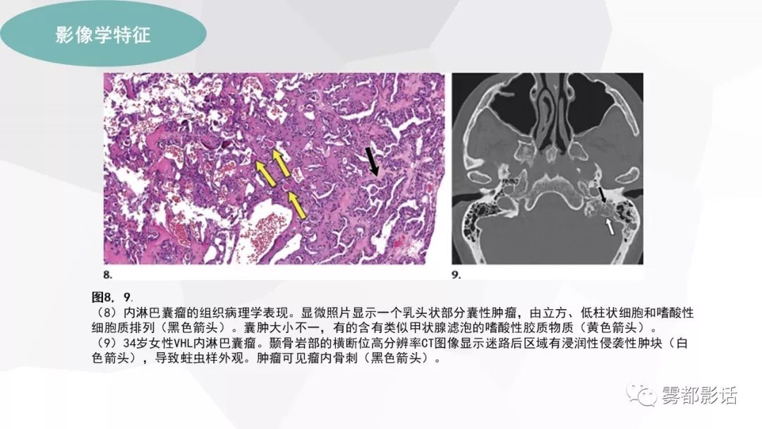 【PPT】希佩尔-林道综合征(VHL 综合征)