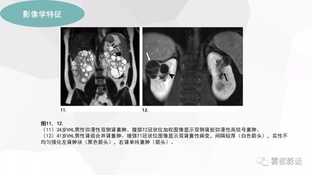 【PPT】希佩尔-林道综合征(VHL 综合征)