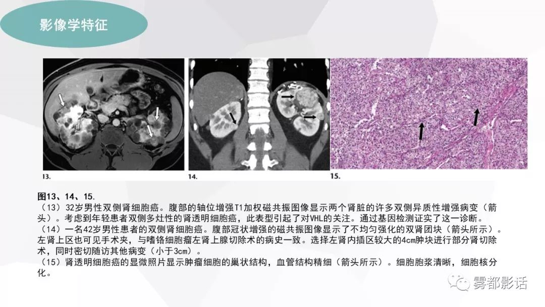 【PPT】希佩尔-林道综合征(VHL 综合征)