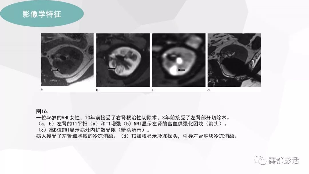 【PPT】希佩尔-林道综合征(VHL 综合征)