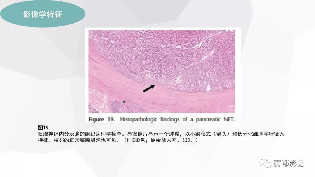 【PPT】希佩尔-林道综合征(VHL 综合征)