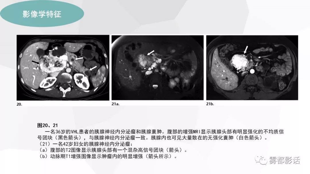 【PPT】希佩尔-林道综合征(VHL 综合征)
