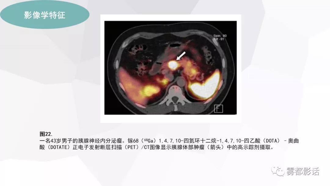 【PPT】希佩尔-林道综合征(VHL 综合征)