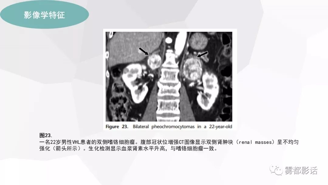 【PPT】希佩尔-林道综合征(VHL 综合征)