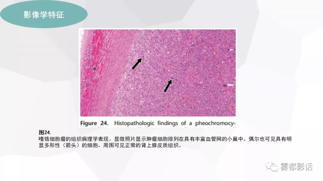 【PPT】希佩尔-林道综合征(VHL 综合征)