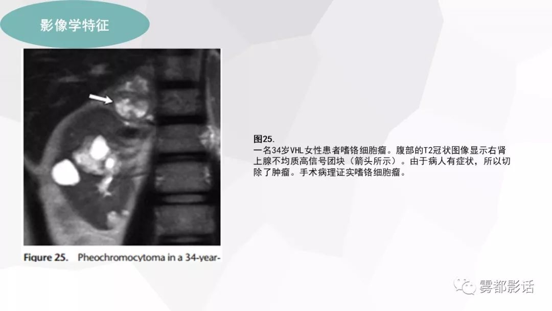 【PPT】希佩尔-林道综合征(VHL 综合征)
