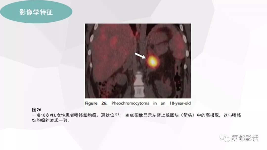 【PPT】希佩尔-林道综合征(VHL 综合征)