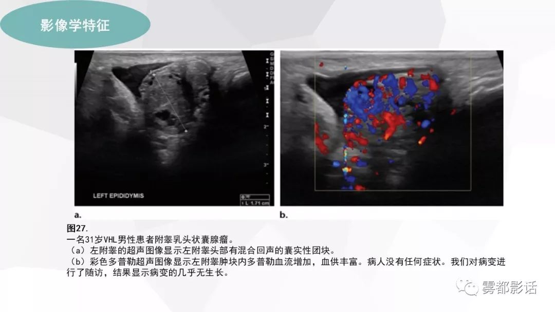 【PPT】希佩尔-林道综合征(VHL 综合征)