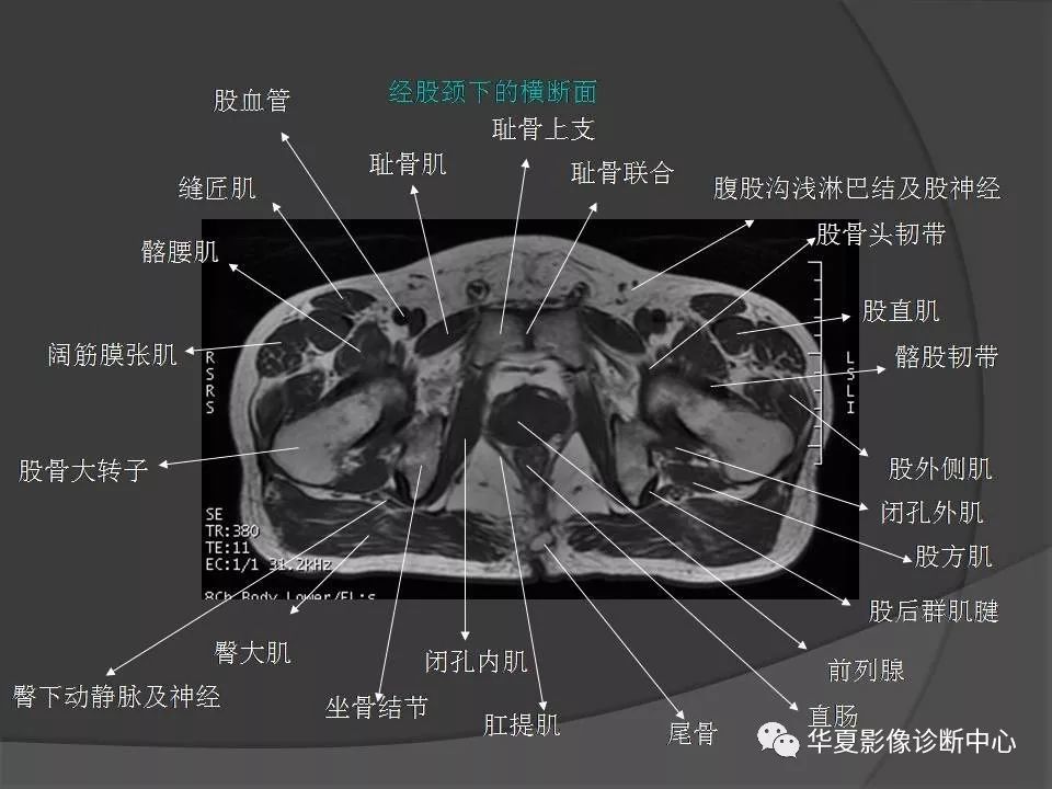 【PPT】骨盆肌肉解剖MRI标识