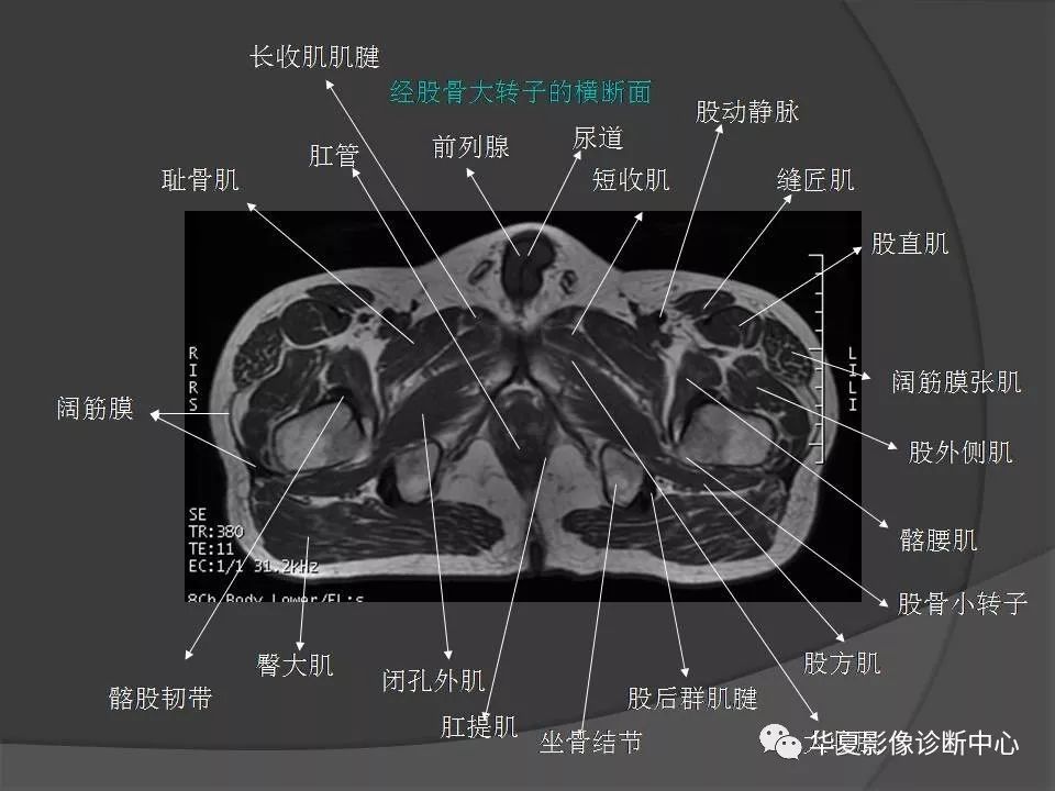 【PPT】骨盆肌肉解剖MRI标识
