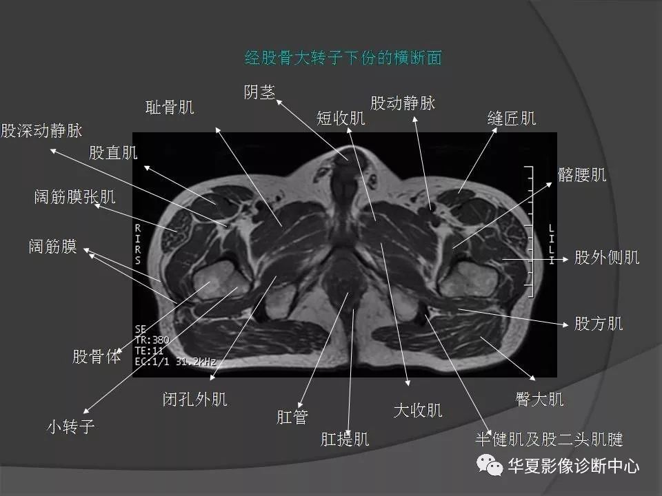 【PPT】骨盆肌肉解剖MRI标识
