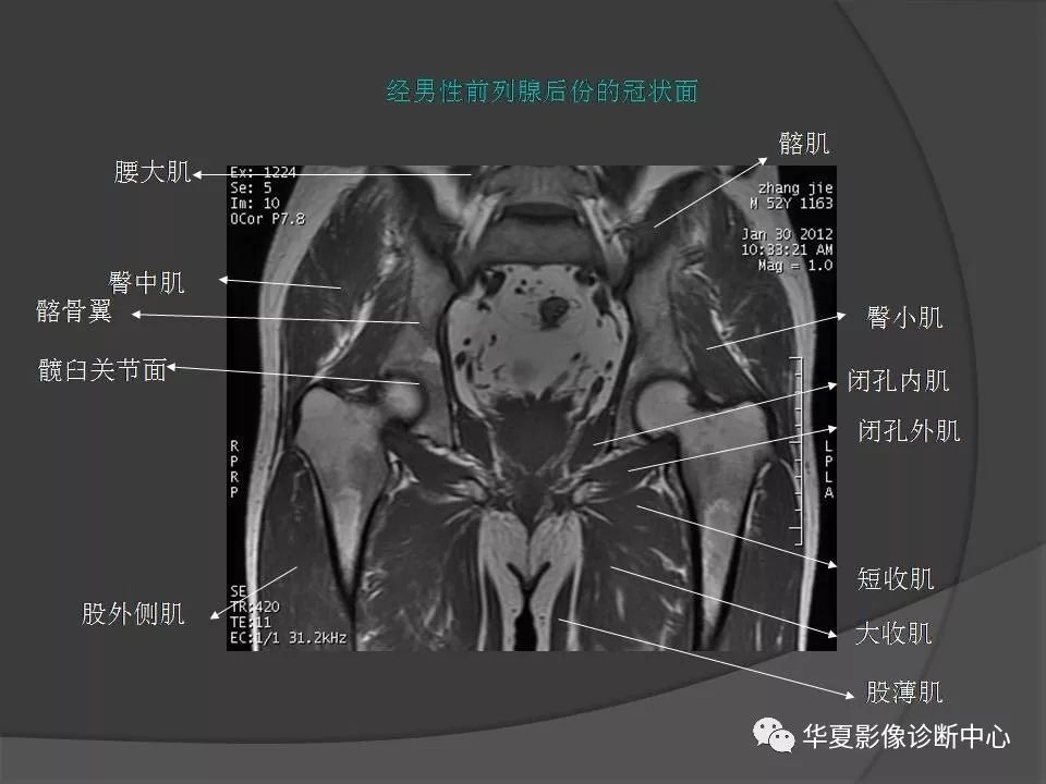【PPT】骨盆肌肉解剖MRI标识