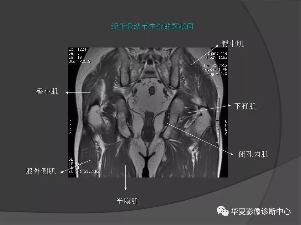【PPT】骨盆肌肉解剖MRI标识