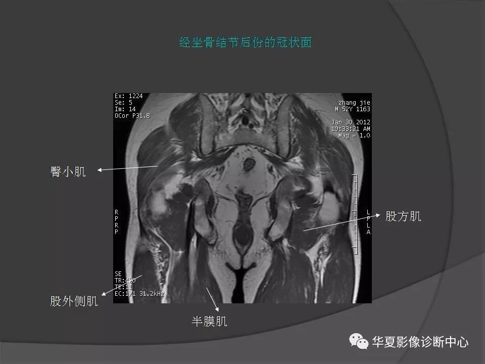 【PPT】骨盆肌肉解剖MRI标识