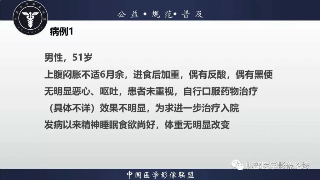 【病例】胃神经鞘瘤1例CT影像