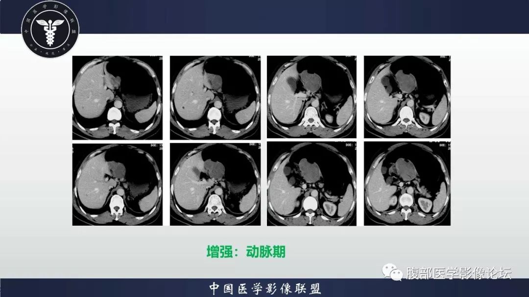 【病例】胃神经鞘瘤1例CT影像