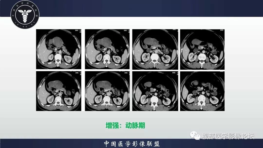 【病例】胃神经鞘瘤1例CT影像