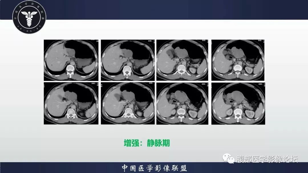 【病例】胃神经鞘瘤1例CT影像