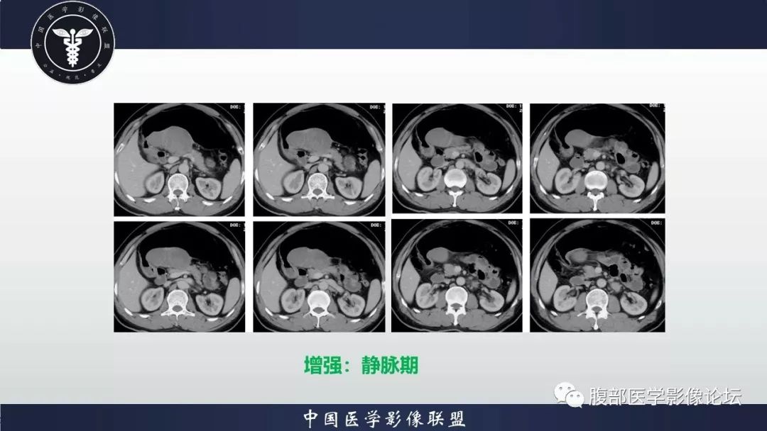 【病例】胃神经鞘瘤1例CT影像