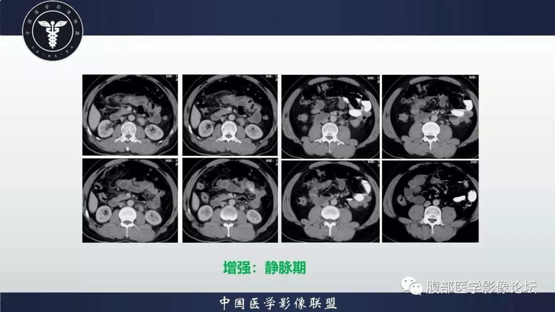 【病例】胃神经鞘瘤1例CT影像