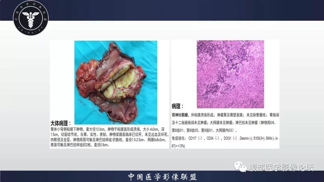 【病例】胃神经鞘瘤1例CT影像