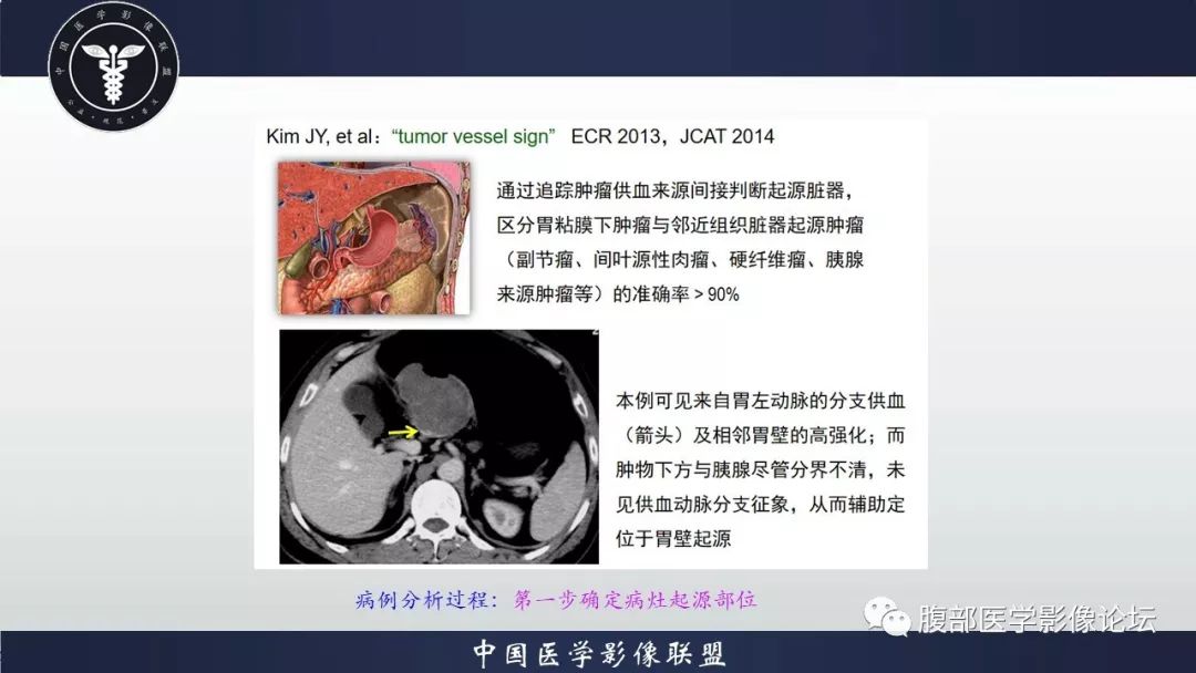 【病例】胃神经鞘瘤1例CT影像
