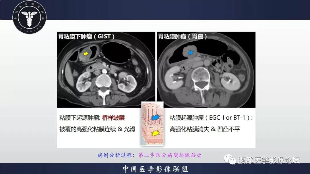 【病例】胃神经鞘瘤1例CT影像