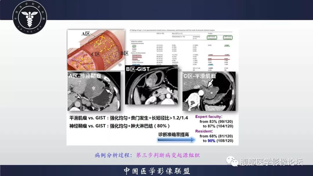 【病例】胃神经鞘瘤1例CT影像