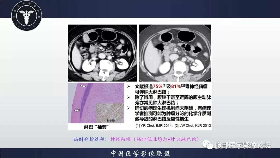 【病例】胃神经鞘瘤1例CT影像