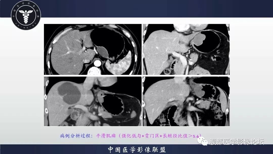 【病例】胃神经鞘瘤1例CT影像