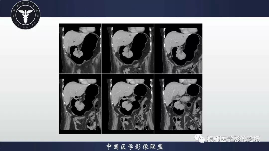 【病例】胃癌1例CT影像