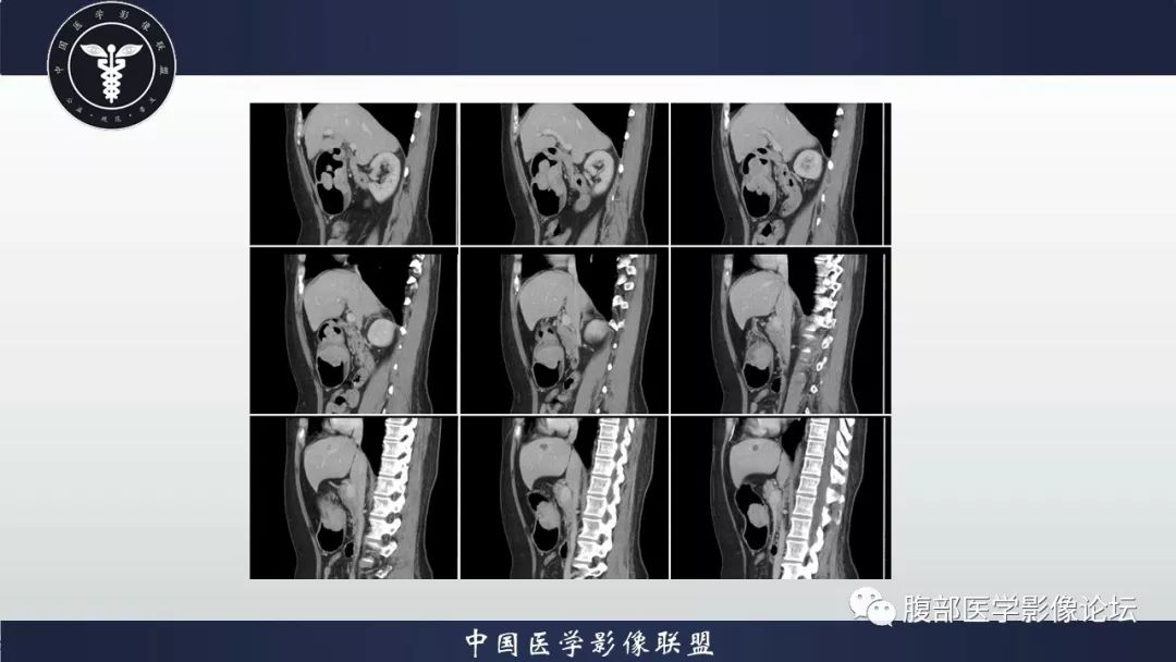 【病例】胃癌1例CT影像